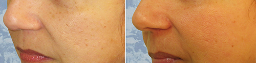 Actual Roberts D.O.T. tone texture & brown spots patient