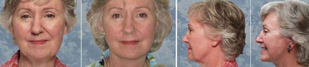 Face Lift Photo