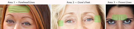 BOTOX and Dysport pricing areas for crow