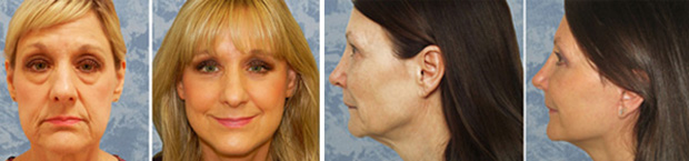 The “Scarless”, Vertical Face Lift – Plastic Surgeon Dallas – Roberts Cosmetic  Surgery