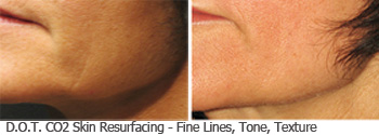 Actual Roberts D.O.T. face fine lines, tone texture patient