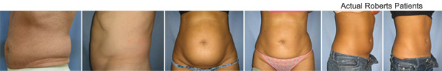 Liposuction Before and After Dallas, Fort Worth and Richardson, TX