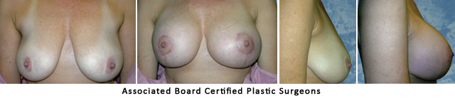  Breast Lift Dallas Fort Worth Metroplex Before & After Pictures 