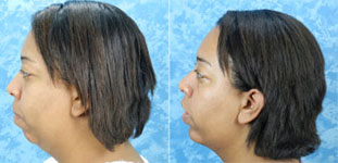 Before & After photos Mentoplasty Chin Implant Surgery