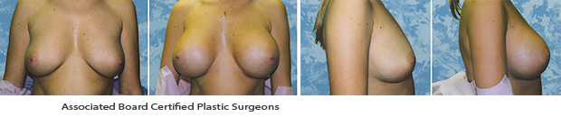  Breast Augmentation Dallas Before & After Picture 