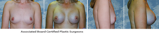  Breast Augmentation Dallas Before & After Picture 