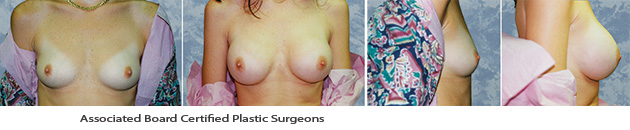  Breast Augmentation Dallas Before & After Picture 