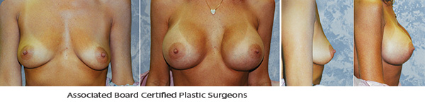  Breast Augmentation Dallas Before & After Picture 