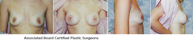  Breast Augmentation Dallas Before & After Picture 