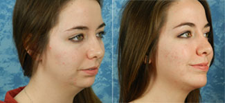 Before & After photos Chin Implant Surgery