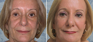 LiquidFaceLift Dallas Before and After 