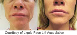 LiquidFaceLift Dallas Before and After 