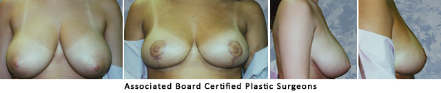  Breast Lift Dallas Fort Worth Metroplex Before & After Pictures 