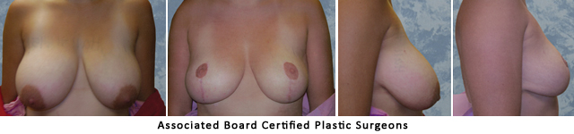  Breast Lift Dallas Fort Worth Metroplex Before & After Pictures 