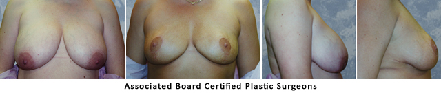  Breast Lift Dallas Fort Worth Metroplex Before & After Pictures 