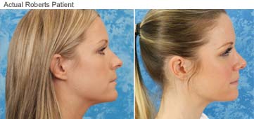 Rhinoplasty Before After Nose Reshaping Photos