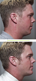 Before & After photos Chin Augmentation Surgery