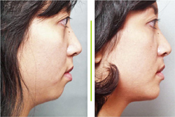 Before & After photos Mentoplasty Chin Augmentation Surgery