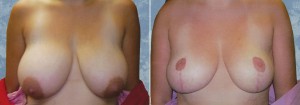 Breast Lift - Reduction         