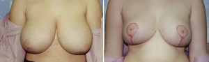 Breast Lift - Reduction  - 1 week       