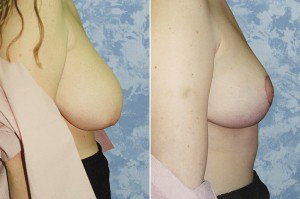 Breast Lift - Reduction - 1 week     