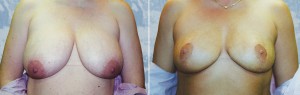 Breast Lift - Reduction         