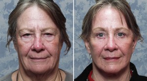 Endoscopic Browlift combined with Upper & Lower Blepharoplasty, Facelift & Facial Resurfacing    