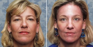Endoscopic Browlift combined with Lower Blepharoplasty & Facial Resurfacing    