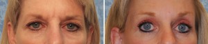 Endoscopic Browlift combined with Facelift    