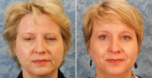 Endoscopic Browlift combined with Lower Blepharoplasty    