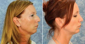 Chin Augmentation & Rhinoplasty  