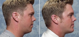 Chin Augmentation with Liposuction of Jawline  
