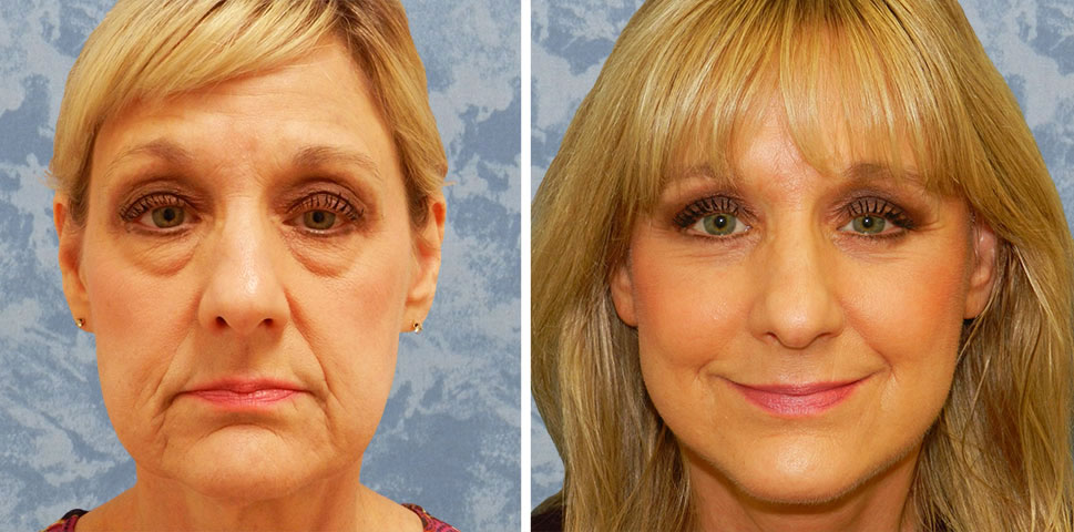 The “Scarless”, Vertical Face Lift – Plastic Surgeon Dallas