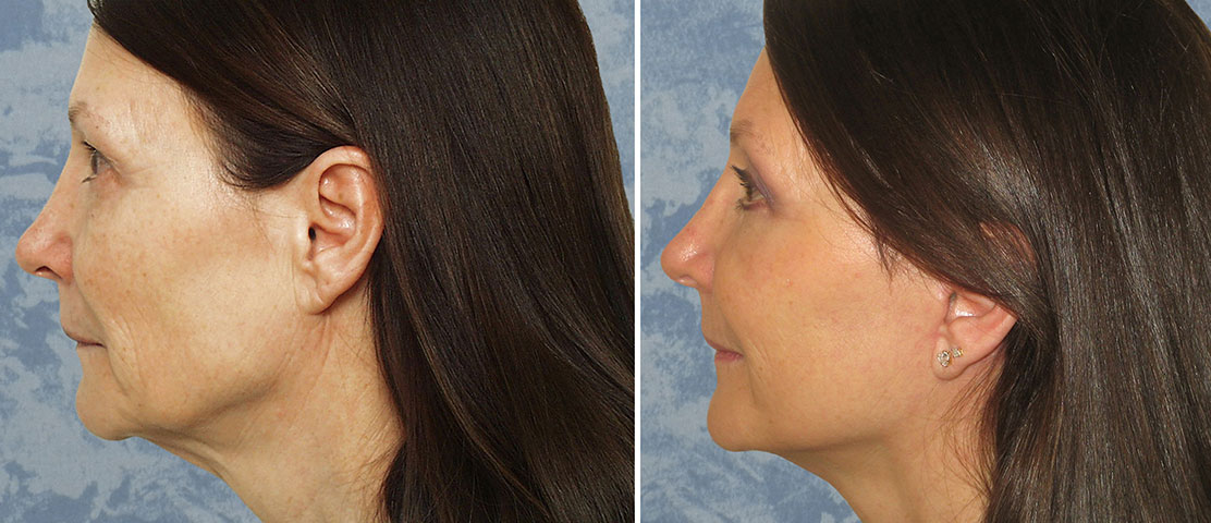 The “Scarless”, Vertical Face Lift – Plastic Surgeon Dallas – Roberts  Cosmetic Surgery