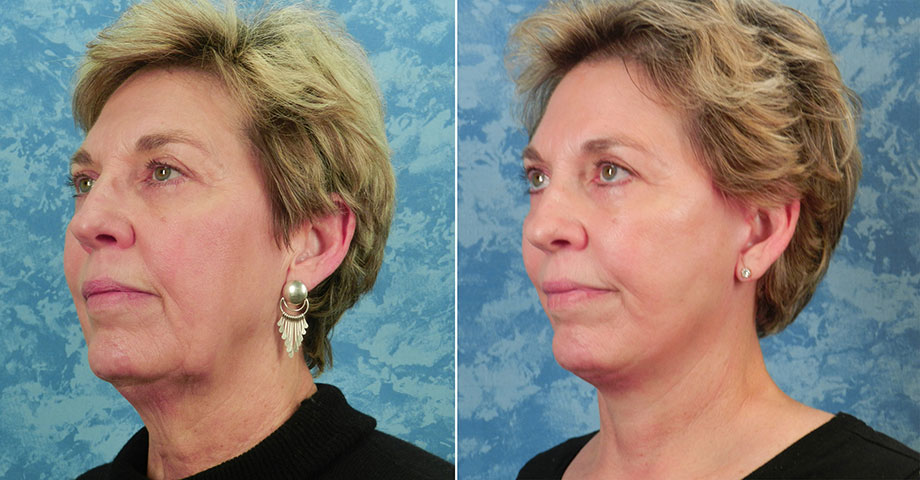 The “Scarless”, Vertical Face Lift – Plastic Surgeon Dallas – Roberts  Cosmetic Surgery