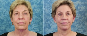 The “Scarless”, Vertical Face Lift – Plastic Surgeon Dallas – Roberts  Cosmetic Surgery