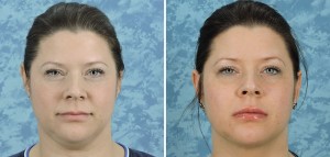 Lip Augmentation with Surgisil Permalip Implant