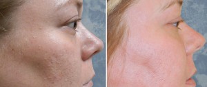 Skin Resurfacing D.O.T. Co2 (1 treatment)  