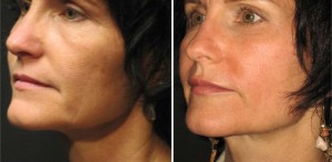 Skin Resurfacing D.O.T. Co2 & Lip Implant (1 treatment)    