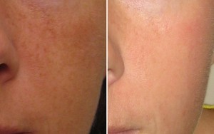 Skin Resurfacing D.O.T. Co2 (1 treatment)   