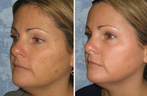 Skin Resurfacing D.O.T. Co2 (1 treatment)     