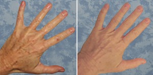 Skin Resurfacing D.O.T. Co2 (1 treatment)    