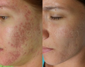 Skin Resurfacing with SkinPen     