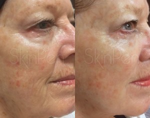 Skin Resurfacing with SkinPen     